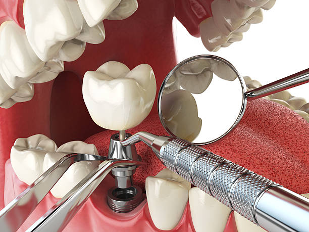 Best Urgent Tooth Repair  in Frankston, TX